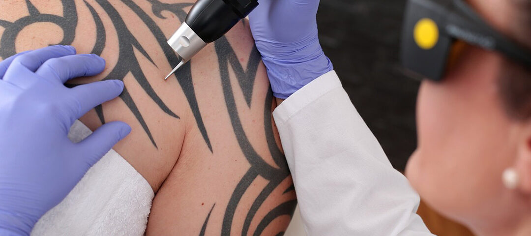 Tattoo Regret? Try Laser Tattoo Removal
