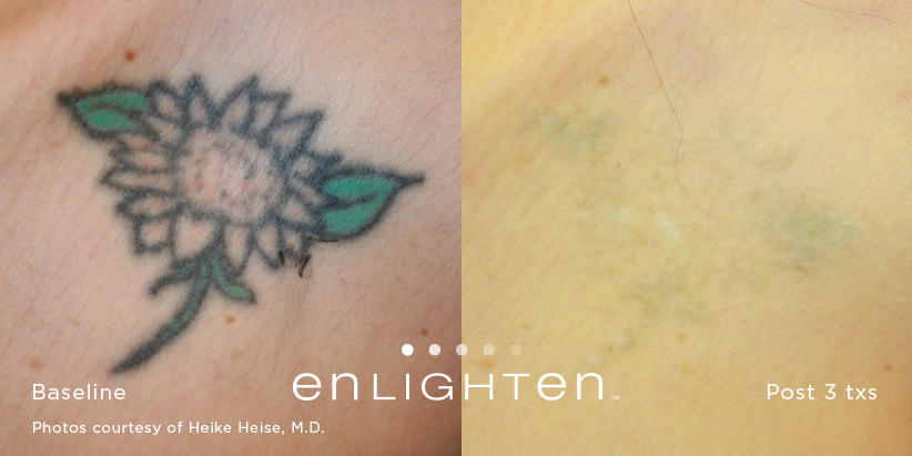 Save with ZendyHealth on Laser Tattoo Removal