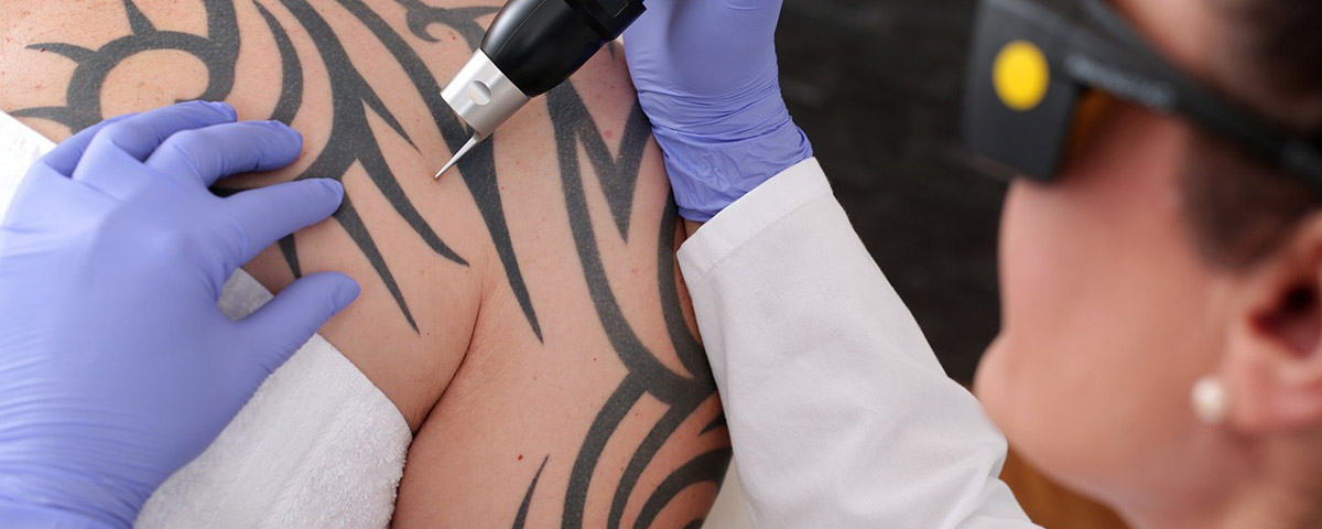 Laser-Tattoo-Removal